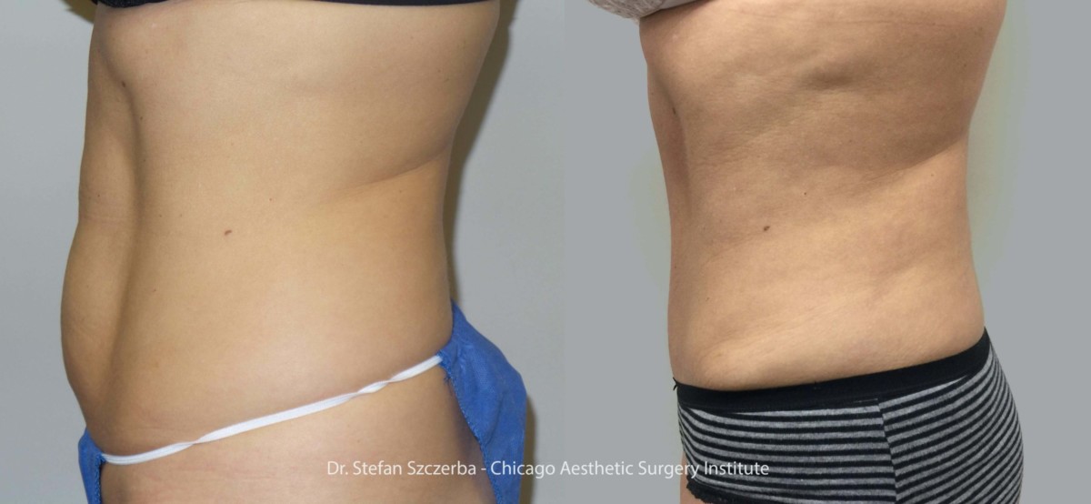 Tummy Tuck – Age 35 – 40 – Height 5’2” – Weight 135 lbs