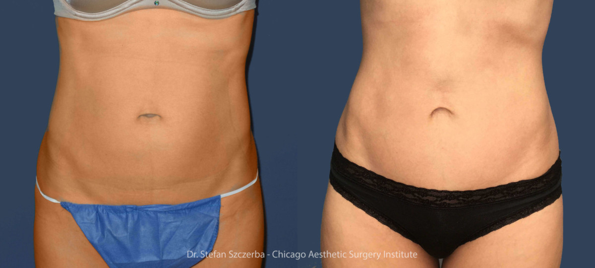 Tummy Tuck – Age 35 – 40 – Height 5’8” – Weight 118 lbs