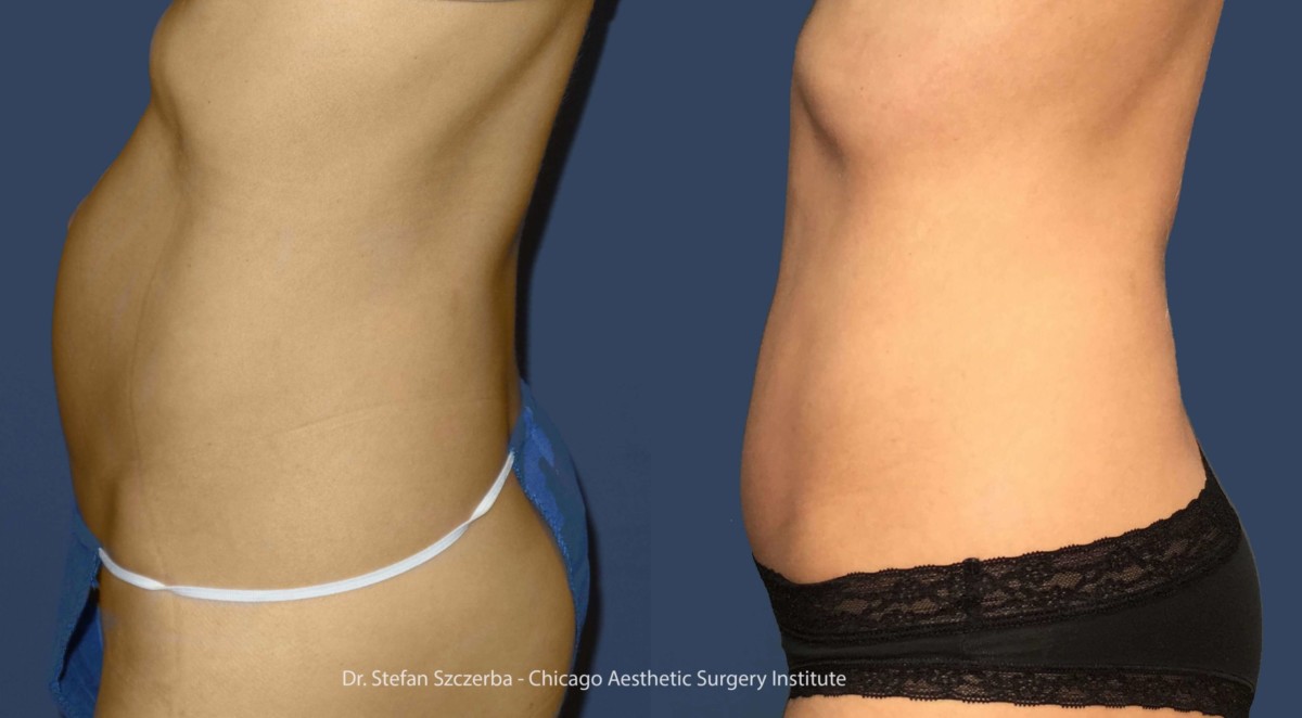 Tummy Tuck – Age 35 – 40 – Height 5’8” – Weight 118 lbs