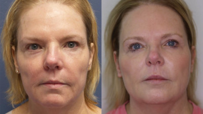 Photo taken after 1, & 3 Years of treatment. PHOTOTHRAPY BBL 590 560 515 - ER YAG 2940 LASER RESURFACING - EXILIS MONOPOLAR SKIN TIGHTENING - HYDRAFACIAL
Juvederm – Botox – Microneedling – Kybella
Age: 55-60