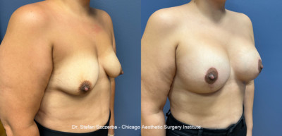 Breast Lift - Lollipop
Breast Augmentation - Mentor, Silicone Smooth Ultra HP 535 cc
Age 42
Height 5'4"
Weight 160 lbs