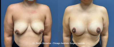 Breast Lift - Lollipop
Breast Augmentation - Mentor, Silicone Smooth Ultra HP 535 cc
Age 42
Height 5'4"
Weight 160 lbs