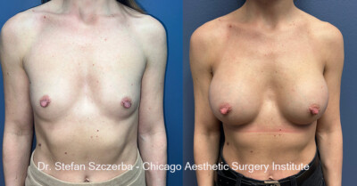 Breast Augmentation - Silicone
Mentor Silicone Smooth Ultra HP 350cc Style 350, 5350BC, Age 39, Height 5'4", Weight 120 lbs