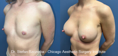Breast Augmentation - Silicone
Mentor Silicone Smooth Ultra HP 350cc Style 350, 5350BC, Age 39, Height 5'4", Weight 120 lbs