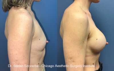 Breast Augmentation - Silicone
Mentor Silicone Smooth Ultra HP 350cc Style 350, 5350BC, Age 39, Height 5'4", Weight 120 lbs