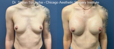 Inspira Smooth Touch Gel SSX-285cc SSX – Extra Full
Age 38
Height 5’3”
Weight 120 lbs
Tattoo Blurred per patient request.