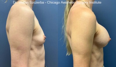 Inspira Smooth Touch Gel SSX-285cc SSX – Extra Full
Age 38
Height 5’3”
Weight 120 lbs
Tattoo Blurred per patient request.