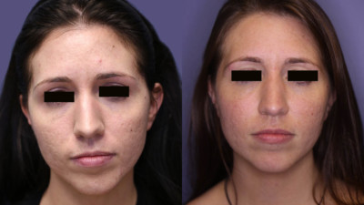 Photo taken after 1, & 4.5 years of treatment. ULTHERA - PHOTOTHERAPY BBL 590 560 420 - ER YAG 2940 PRO FX + LASER RESURFACING
LHR – Microneedling – Hydrafacial - Botox
Age: 30 - 35