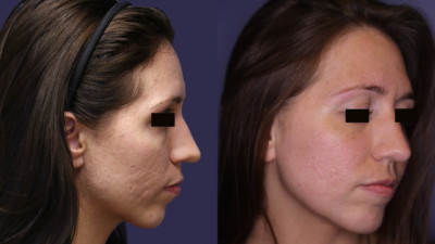 Photo taken after 1, & 4.5 years of treatment.
ULTHERA - PHOTOTHERAPY BBL 590 560 420 - ER YAG 2940 PRO FX + LASER RESURFACING
LHR – Microneedling – Hydrafacial - Botox
Age: 30 - 35