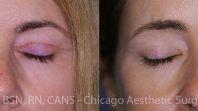 Treatment : ULTHERA NECK - LASER RESURFACING ER YAG 2940 + PHOTOTHRAPY BBL 590 560 515
Botox, - Juvederm – Sculptra
Age: 45-50