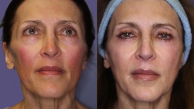 Photo taken after 1, & 2 years of treatment. Laser resurfacing, laser bleph ErYag 2940 BBL 590 560 515 NdYAG 1064 Face neck chest, Forma bipolar RF, Fractora RF microneedling, Exilis monopolar RF, Sculptra, Juvederm, Botox. Patient treated periodically for two years.
Age: 55-60