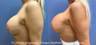 Implant Exchange Mentor Silicone Smooth Ultra HP 700cc
Age 45
5’3
123lbs.