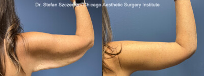 Brachioplasty | Age 51 | Height 5’3” | Weight 150 lbs