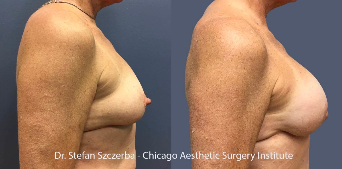 Reconstruction
Removal of tissue expander exchanged for permanent implant, Allergan SCX 750cc cohesive silicone implant
Age 60-65
Height 5’2”
Weight 155 lbs