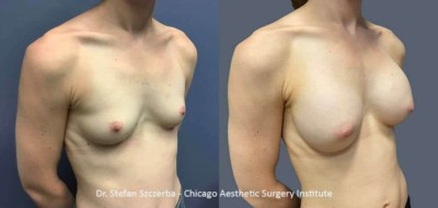 Breast Augmentation | Mentor silicone smooth ultra HP295oc | Age 30-35 | Height 5’2” | Weight 110 lbs