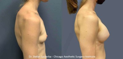 Breast Augmentation | Mentor silicone smooth ultra HP295oc | Age 30-35 | Height 5’2” | Weight 110 lbs