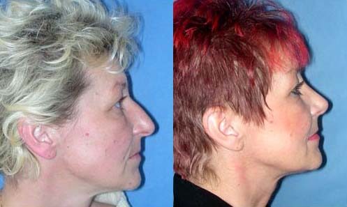 Nasal-reshaping-before-after-01