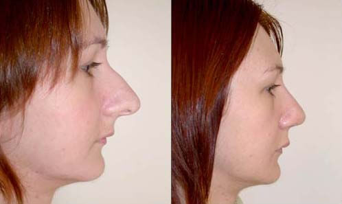 Nasal-reshaping-before-after-02