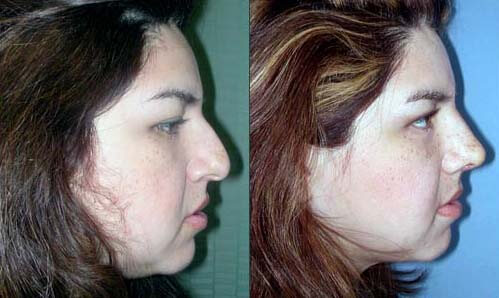 Nasal-reshaping-before-after-03