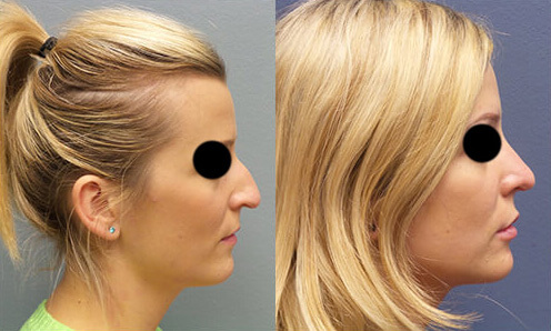 Nasal-reshaping-before-after-04